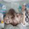 Conjoined twins separated in 27 hour operation